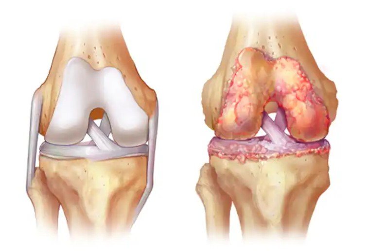 هزینه‌های درمانی آرتروز زانو